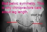 short_leg_xray.jpg