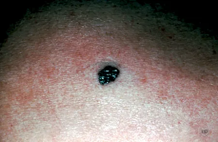 Melanoma