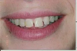 Photo of smile before Veneers applied in Winter Garden, FL