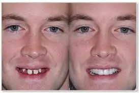 before and after image of man smiling missing teeth, then man smiling after tooth replacement dental implants dentist Melrose, MA