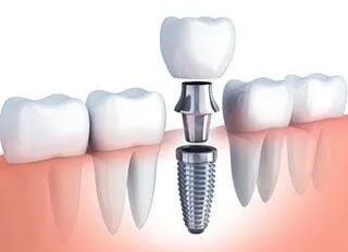 illustration of teeth and gums, showing dental implant assembly to replace tooth, dental implants Old Bridge, NJ dentist