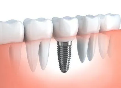 single dental implant embedded in jaw with natural teeth, dental implants Lincoln, NE dentist
