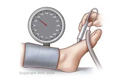 Ankle-Brachial-Index-or-ABI-Test
