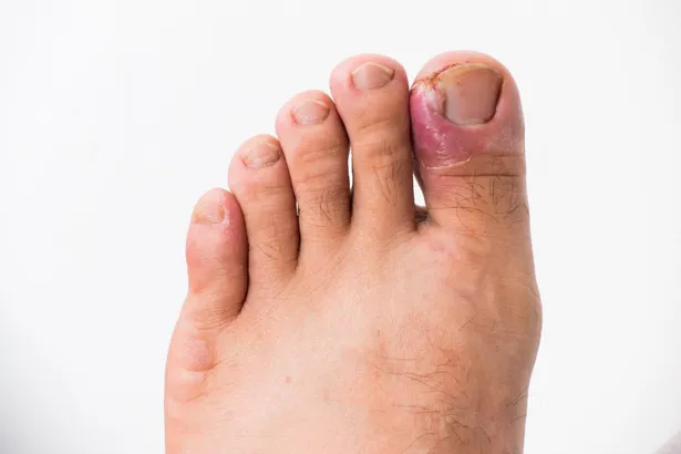 Ingrown Toenail in Westbury, NY