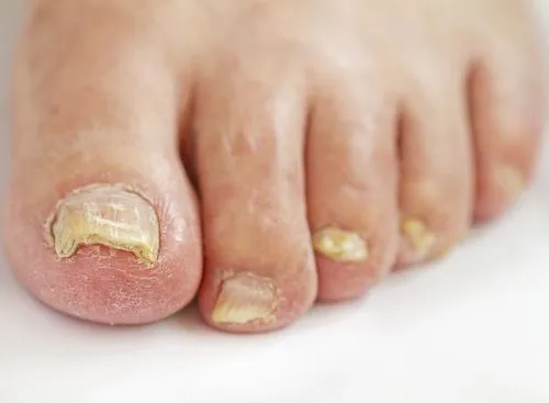 Close-up of toenails affected by fungal infection