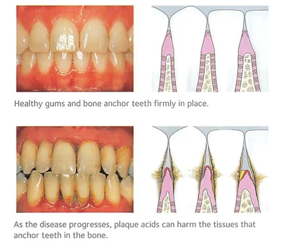 Health Gums and Gum Disease