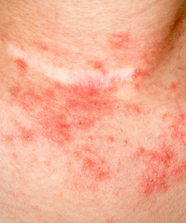 eczema