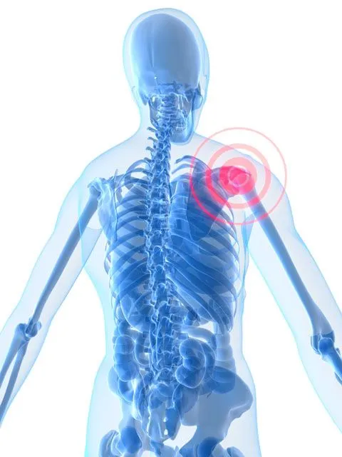 Illustration of shoulder pain