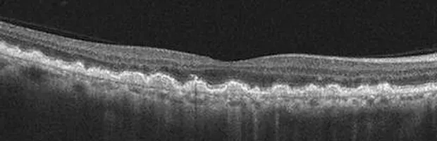 Macular edema