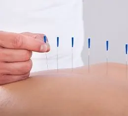 acupuncture