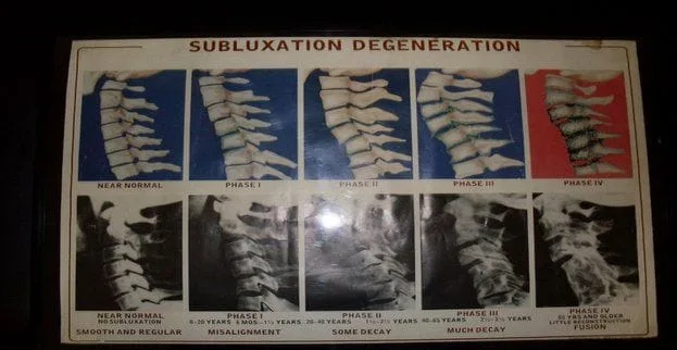 Lindenhurst Chiropractor | Lindenhurst chiropractic Spinal Degeneration | NY |