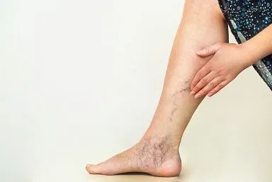 varicose veins in Kailua Kona, HI