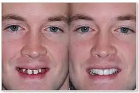 before and after image of man smiling missing teeth, then man smiling after tooth replacement dental implants dentist Melrose, MA