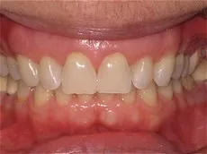 Invisalign