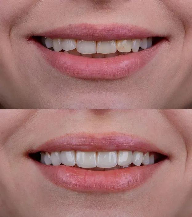 Veneers
