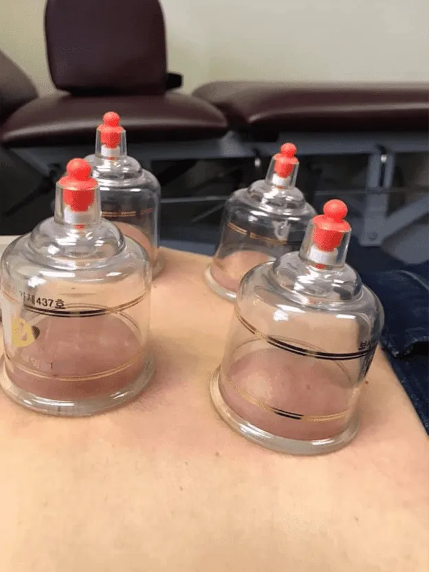 cupping image