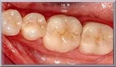 Tooth Colored Fillings