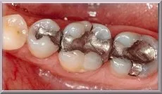 Tooth Colored Fillings