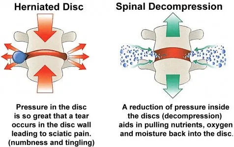 Spinal Decompression Tumwater Lacey