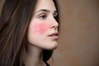 Close-up of woman with rosacea on face