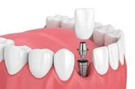 illustration showing crown and implant assembly in mouth, dental implants South Orange, NJ family dentist