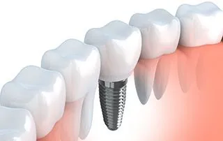 illustration of natural teeth and roots next to embedded dental implants Farmingdale, NY dentist