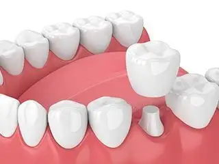 3D computer illustration of teeth and gums, dental crown being placed over tooth, dental crowns Reno, NV general dentistry