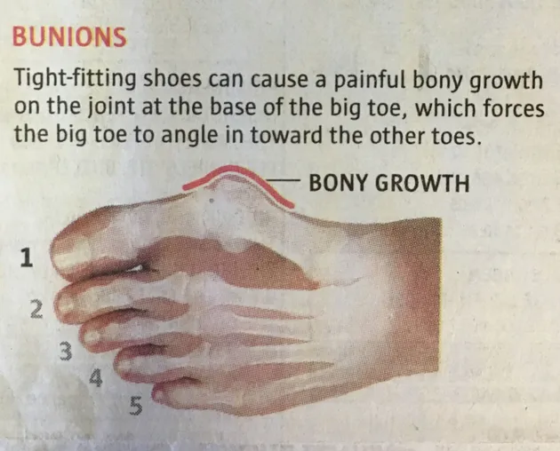 Bunions