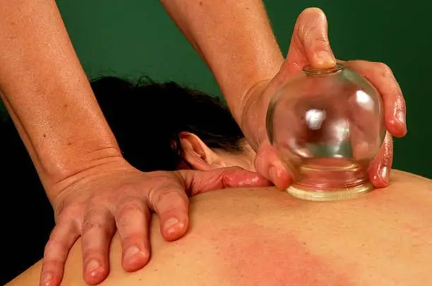 chiropractor is doing some Therapeutic Cupping massage to the patient 