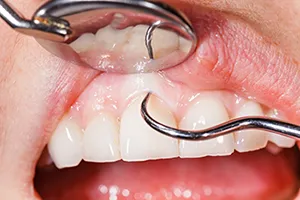 close up of person's mouth, dental tools examining gums and teeth for periodontal gum disease Novi, MI dentist