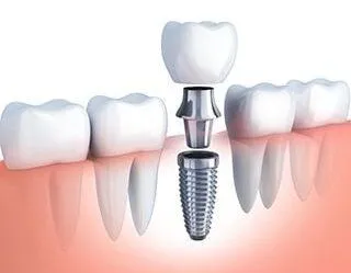 illustration of row of teeth, single dental implant being assembled to replace missing tooth, dental implants Naperville, IL dentist