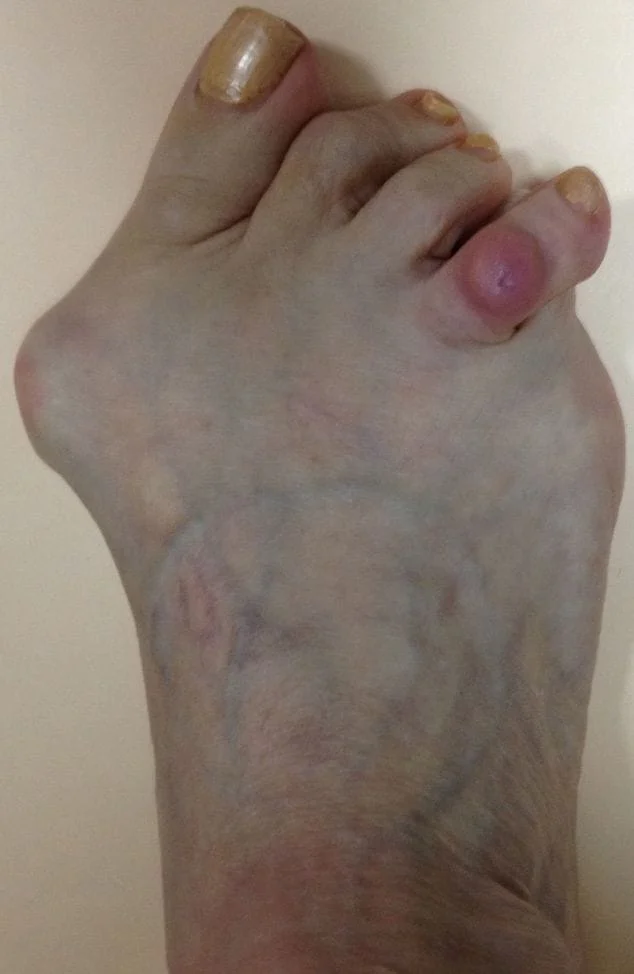 Right Foot Before Crossover Toe Surgery