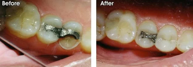 before and after crown