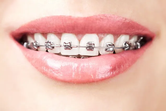 braces in broken arrow, ok