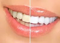 Close up photograph of woman's smile comparing before and after teeth whitening in Portland, TN 