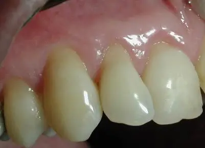Gum Recession- Alloderm