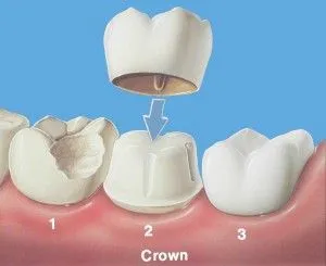 illustration of dental crown being place over damaged tooth to restore it, dental crowns Elgin, IL dentist 