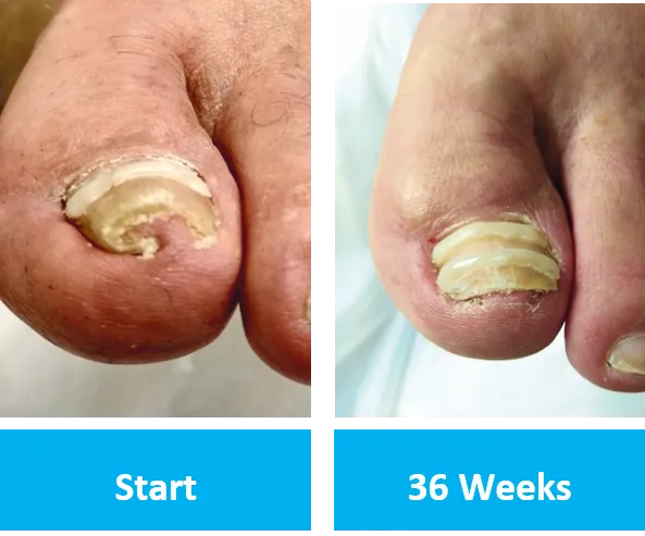 Onyfix before and after