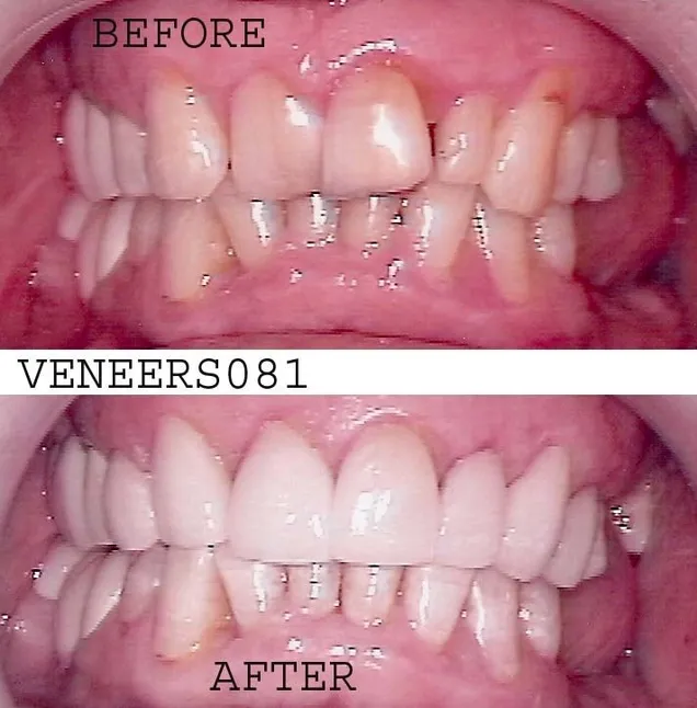 CASE 2 This male patient came to see me for a consult with spaces between his teeth, as he was missing a front tooth which caused the rest of his teeth to be crooked. He refused to consider orthodontics. As seen on his "Before" picture even his gum line were uneven. Once again we got a mockup made for me which he loved. I then proceeded to make porcelain veneers on him, after trimming his gum tissue to make sure that was even, because that makes a huge difference in the final result. He opted for whiter teeth and he was extremely happy after completion of treatment as seen in his "After" picture.