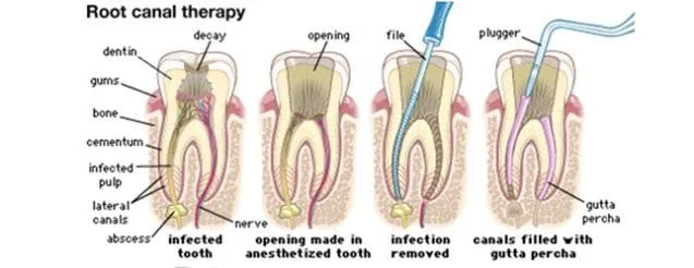 Root_canal_1.jpg