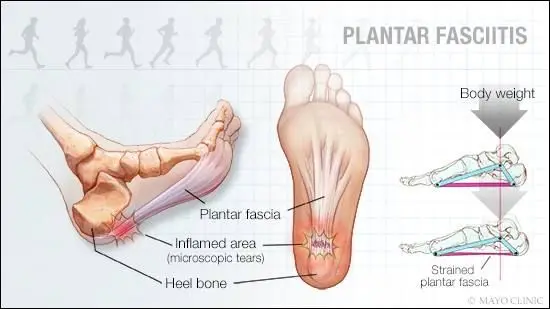 Plantar Fasciitis Westbury, NY