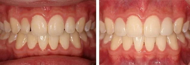 before and after bite of dental patient