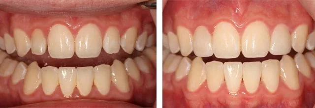 Before and after smile dental patient