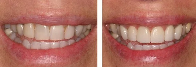 before and after photo with crowns and venners