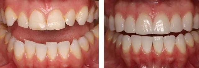 Needham Dentist smile makeover before and after