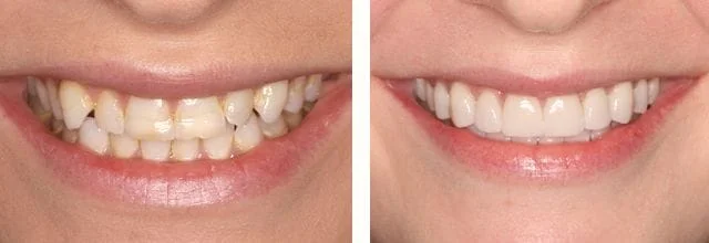 full mouth makeover smile Needham Dentist