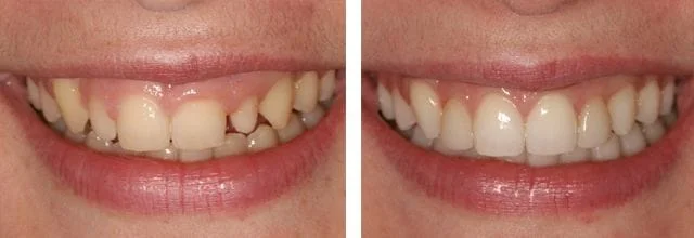 before and after photo comp venner smile