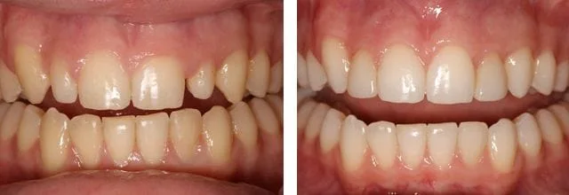 Before and After bite with comp veneer
