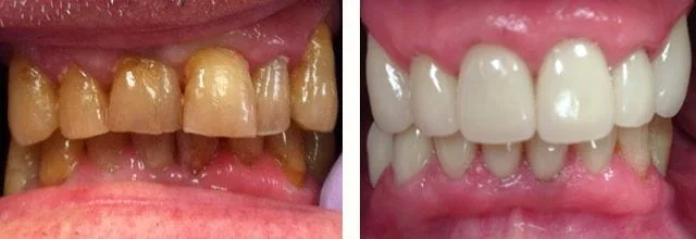 picture of dental work with crowns