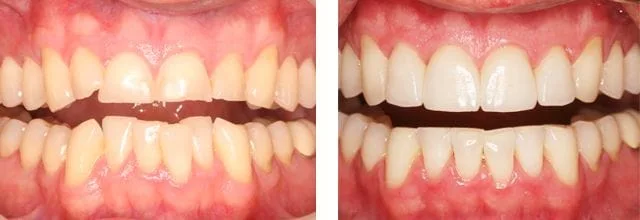 Needham dental work before and after